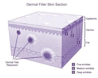 Placement of Dermal Fillers